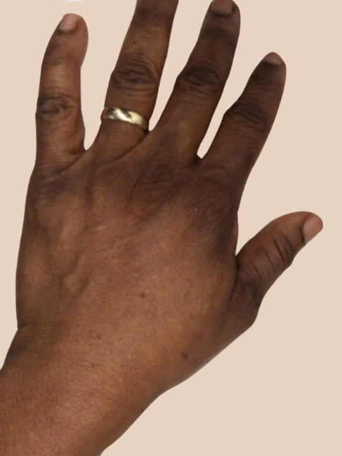 hand rejuvenation with fillers new york city